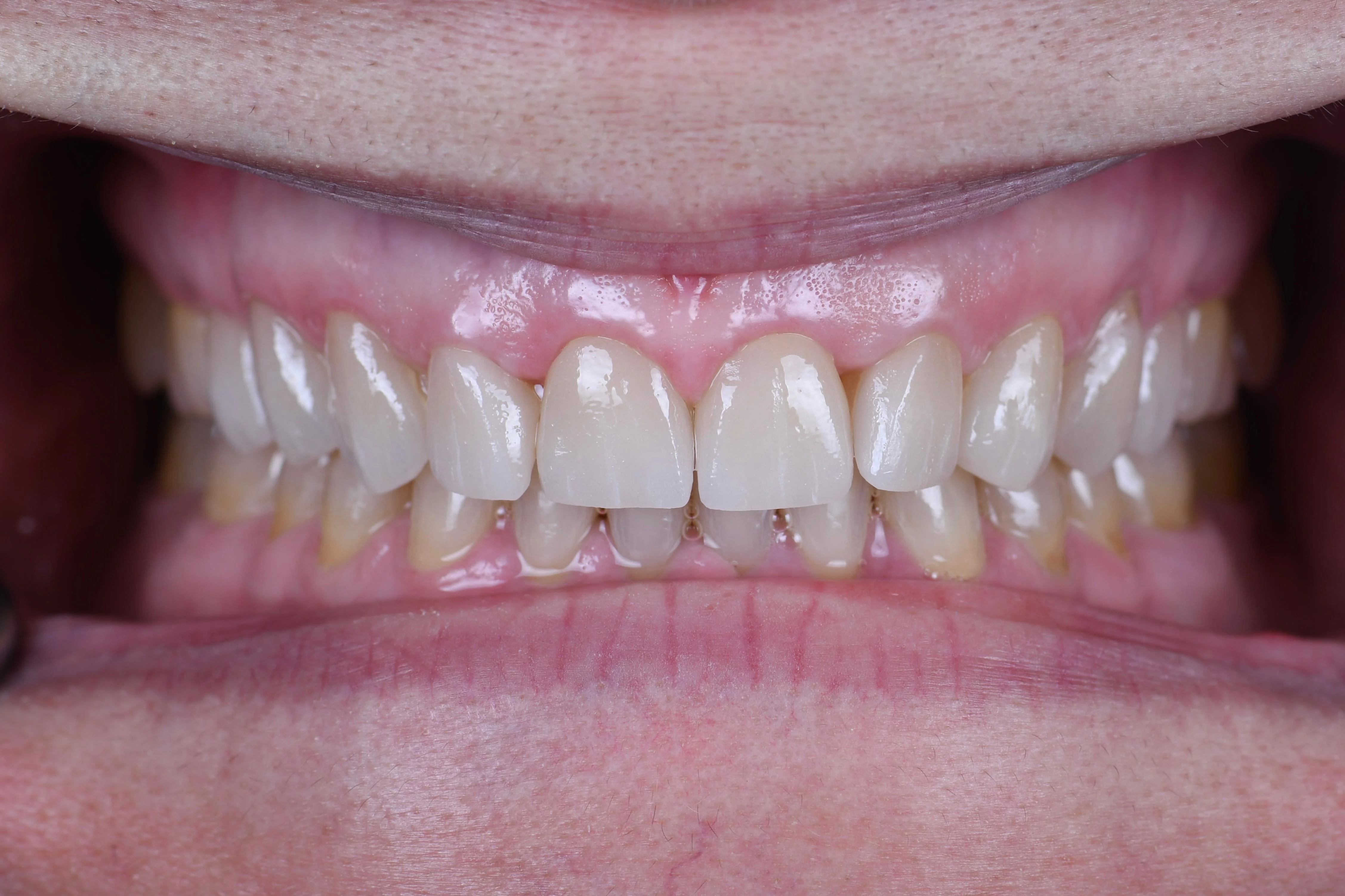 Veneers case 1