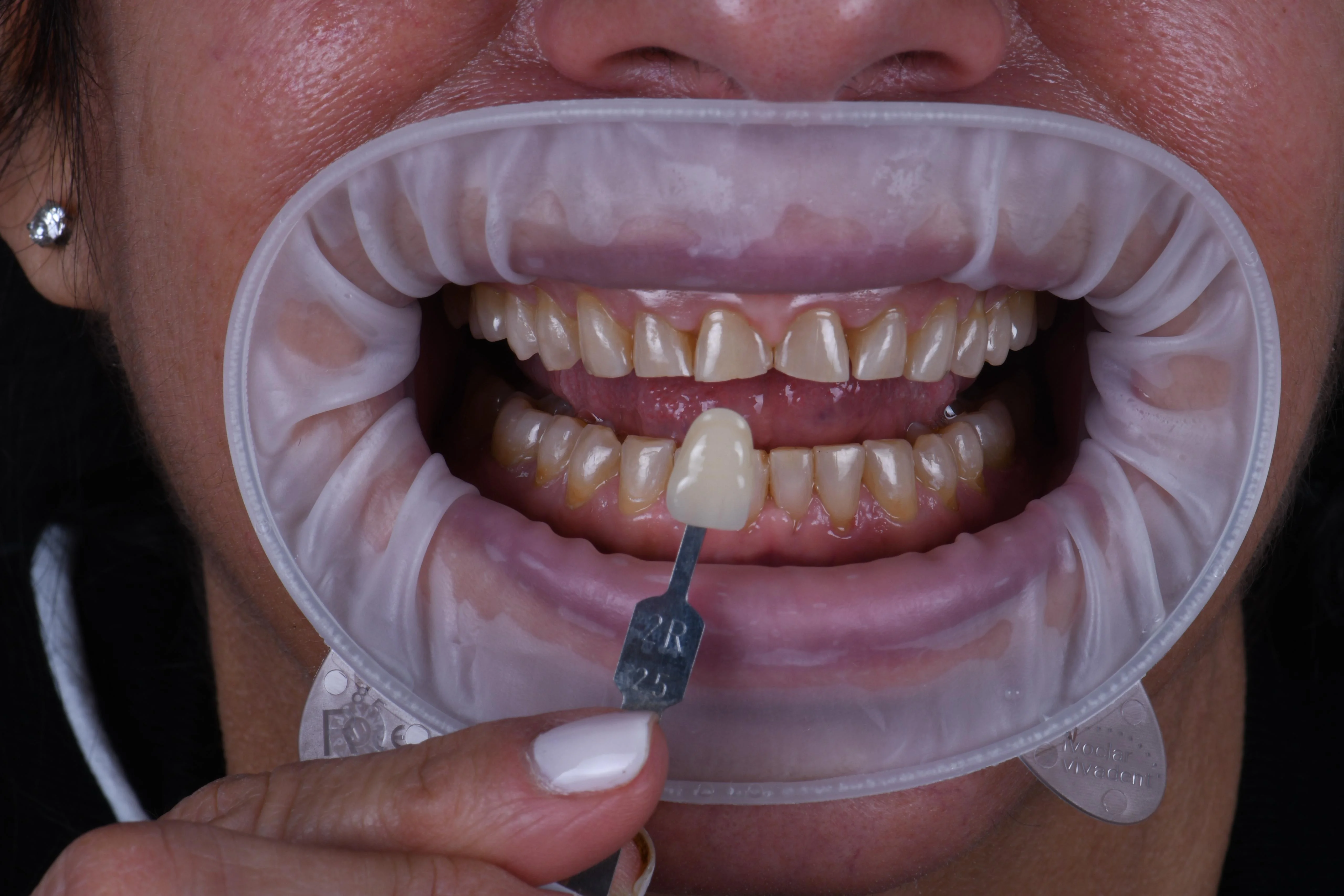 Veneers case 2